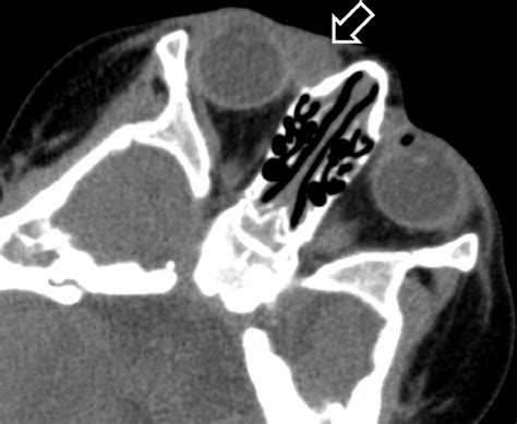 Orbital Ct Scan Axial Image Showing A Cystic Mass At The Medial