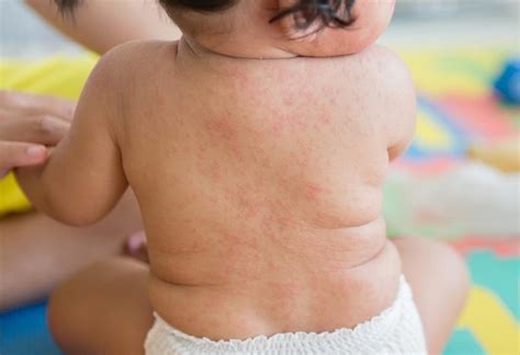 Viral Rash In Infants Types Diagnosis And Treatment
