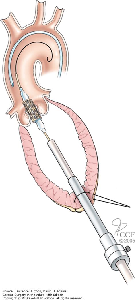 Percutaneous Treatment Of Aortic Valve Disease Thoracic Key