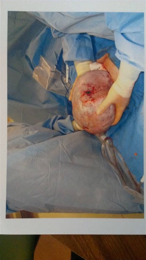 What An Actual Gigantic Ovarian Cyst Looks Like Wtf