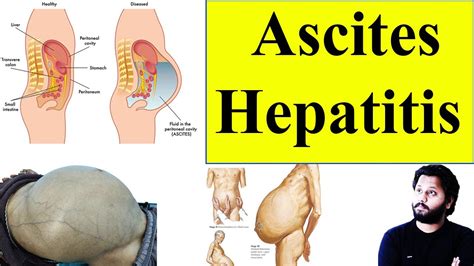 Case 7 Ascites Hepatitis Liver Disease लीवर में पानी पेट में पानी पड़ना Dr Prateek