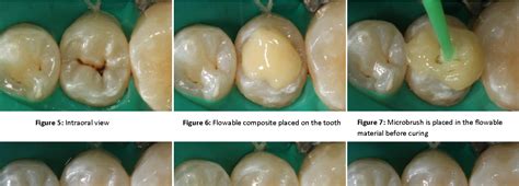 Figure 5 From Direct Posterior Composite Restorations Using Stamp