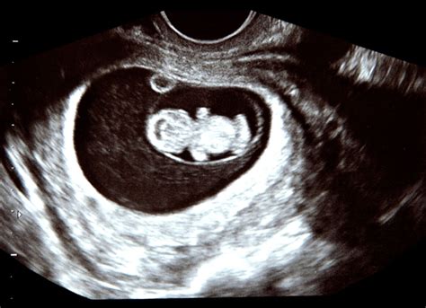 Placenta Praevia Ist Ein Kaiserschnitt Unumgänglich 9monatede