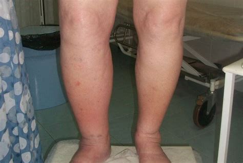 DVT symptoms calf pictures | Symptoms and pictures