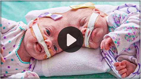 These Twins Were Born Joined At The Head That’s What They Look Like Now Unique Ideas Blog