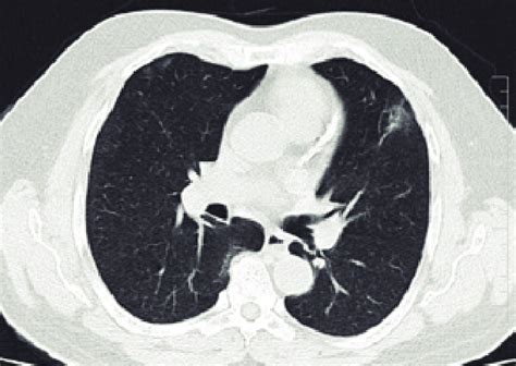 B Hrct Chest Showing Subpleural Ggo With Increased Reticulation In