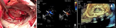 Intraoperative View Of The Mitral Valve After The Open Heart Repair C