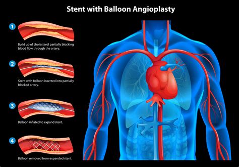 Stent With Balloon Angioplasty 365557 Vector Art At Vecteezy