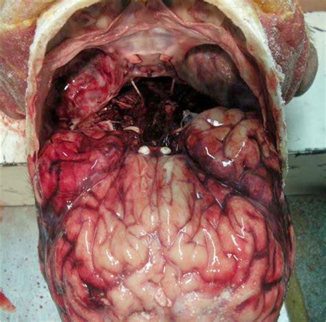 R ifled weapons include handguns an important aspect of describing and documenting gunshot wounds is the ability to recognise not only. Pathology Outlines - Gunshot wounds