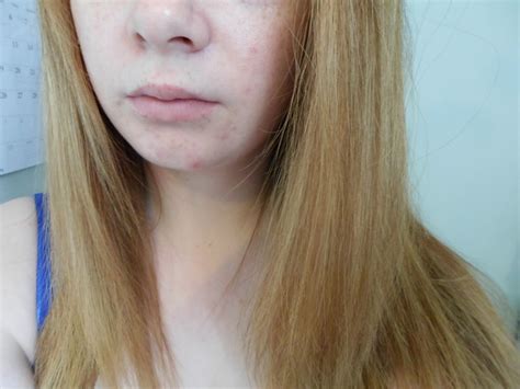 Duggydimples Vichy Dermablend Foundation Review Beforeafter Shots