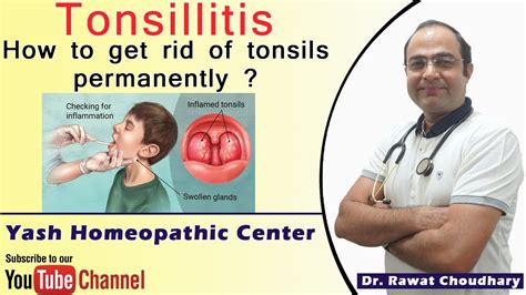 Tonsillitis से हमेशा के लिए छुटकारा पाए Best Treatment Of Tonsils Or