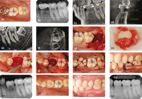 11 Autotransplantation Of Teeth Pocket Dentistry