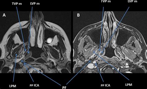 Axial Magnetic Resonance Imaging At The Level Of The Nasopharynx