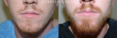 Beard Transplant Miami Facial Hair Implants Beard Hair Transplant
