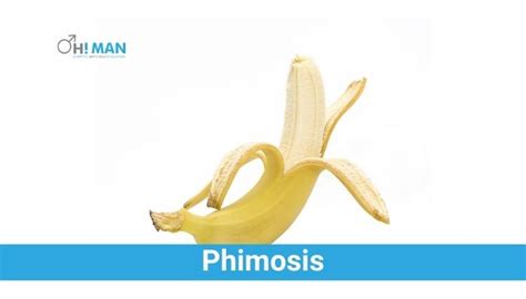 What Is Phimosis Its Causes Symptoms And Treatment Ohman