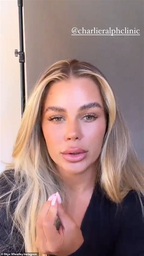 Big Brother Star Skye Wheatley Reveals She Is Getting Her Lip Filler Dissolved Daily Mail Online