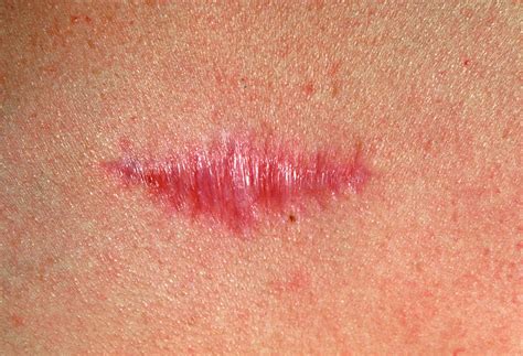 Keloid Scar Photograph By Gary Parkerscience Photo Library Pixels