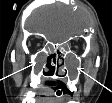 Paranasal Sinuses Computed Tomography Scan Coronal View Fluid In The