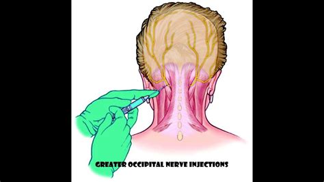 Greater Occipital Nerve Injections My Experience Youtube