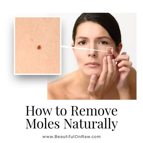 Skin Moles Removal And Prevention Beautiful On Raw