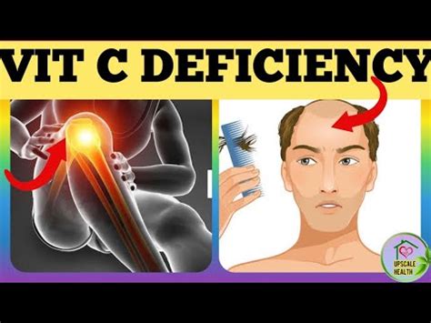 Vitamin C Deficiency Symptoms That Should Never Be Ignored YouTube