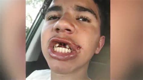 Fla Man Who Punched 12 Year Olds Teeth Out And Called Him Racial