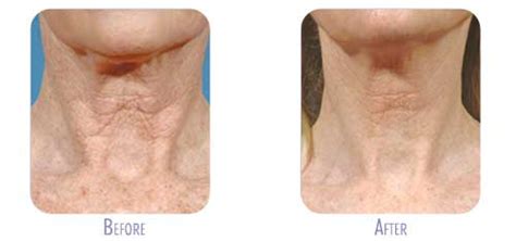 Maybe you would like to learn more about one of these? Fraxel Before and After Gallery | BodyLase® Med Spa ...
