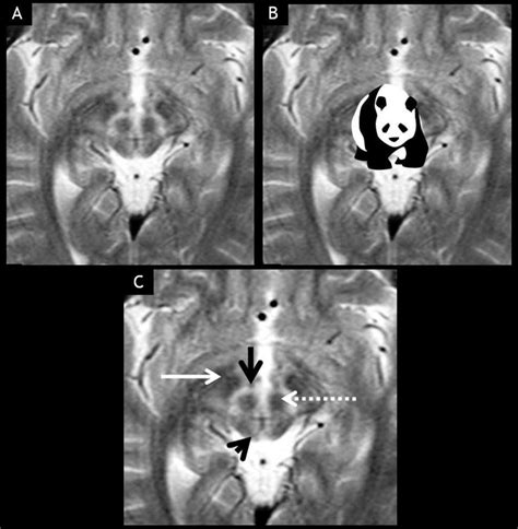 A B Giant Panda Sign In A Young Patient Of Wilson Disease C The
