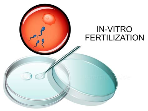 In Vitro Fertilisation Vishvas Fertility And Gynaecology Centre