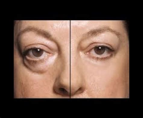 Remove Eye Bags Instantly Argireline Cream Products Are Often Called