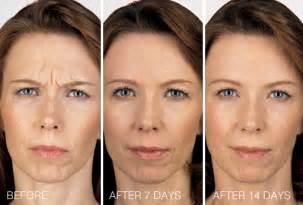 Facial Rejuvenation Md Dr Beth Comeau