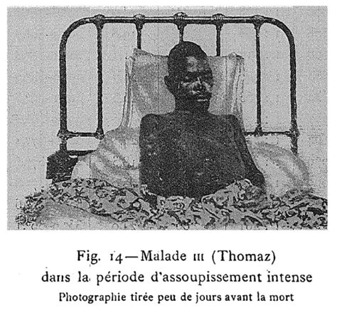 Maladie du sommeil THA Société Francophone de Médecine Tropicale et Santé Internationale