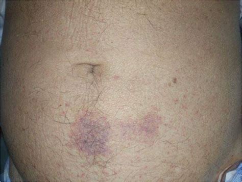 Figure 1 Purpura And Ecchymoses In The Abdomen Of The Patient