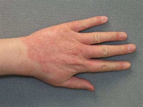 It occurs because the skin has been exposed to a substance that irritates it or causes an allergic reaction. Allergic Contact Dermatitis - Types, Causes & Treatments ...