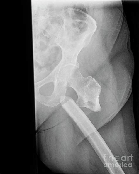 Fractured Femur Photograph By Science Photo Library Fine Art America