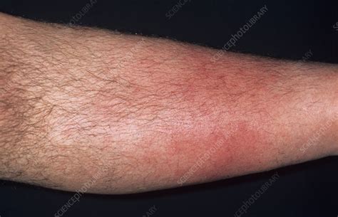 Recurrent Cellulitis Stock Image M1300739 Science Photo Library