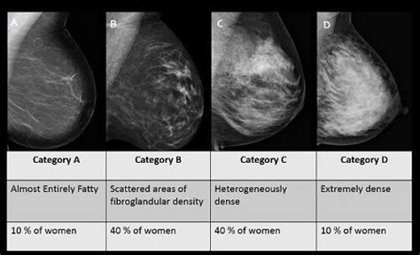 Information About Dense Breast Tissue Treatments Patients And Families Uw Health