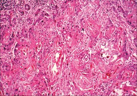 Urethral cancer is a rare cancer originating from the urethra.1 the disease has been classified by the tnm staging system and the world health organization.134. Urethral Neoplasms; Cancer of Urethra; Urethral Cancer