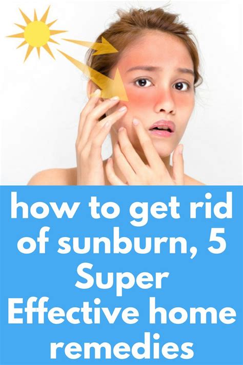 How To Get Rid Of Sunburn 5 Super Effective Home Remedies Sitting