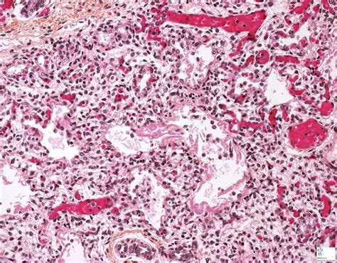 Hyaline Membrane Disease Humpath Com Human Pathology