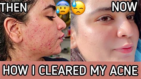 How I Cleared My Skin Pcos Cysticacne Youtube