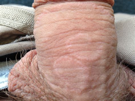 Rash On Penile Shaft Pictures Photos