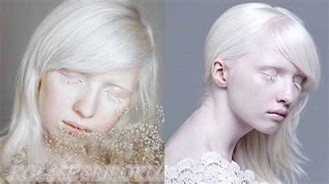 Gadis Albino Ini Sering Dihina Si Muka Pucat Tapi Saat Matanya Dibuka