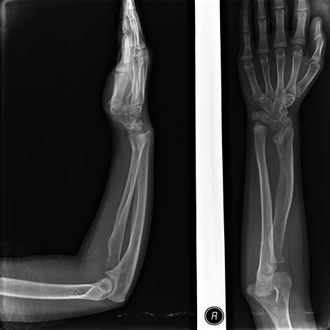 Madelung Deformity Radrounds Radiology Network