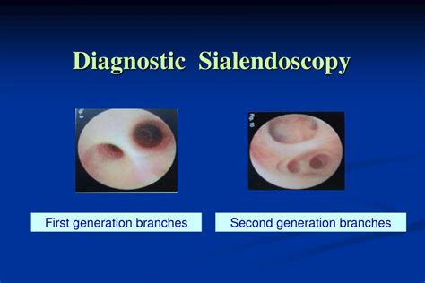 Ppt Chronic Obstructive Sialadenitis And Sialendoscopy Powerpoint