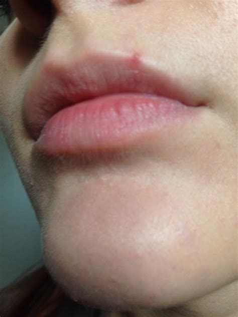 How Do I Treat This Pimple On My Lip Also Does It Look Like It Could