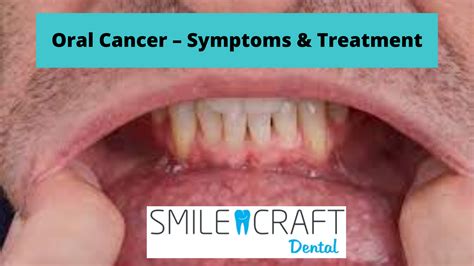 Oral Cancer Symptoms And Treatment