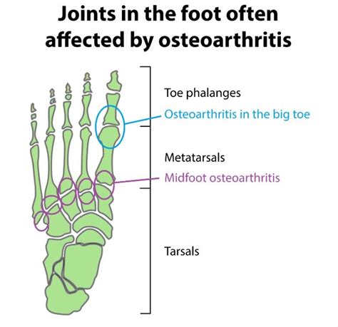 Rheumatoid Arthritis And Osteoarthritis How Your Podiatrist Can Help