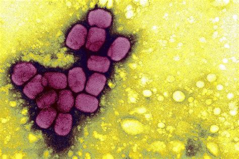 Smallpox is only alive in two labs. Should we destroy it? - Vox