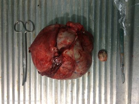 Dermoid Ovarian Cyst The Hauns In Africa